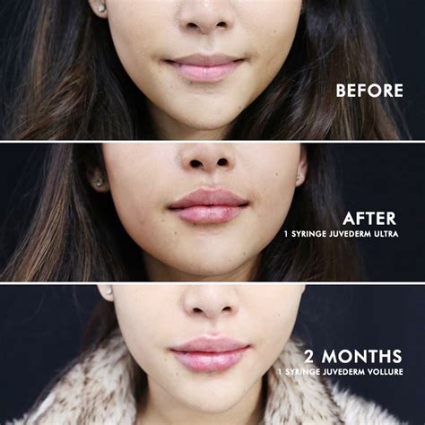 Big Lips Surgery Before And After | Lipstutorial.org