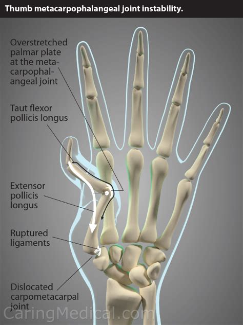 Carpal Metacarpal Joint Injection