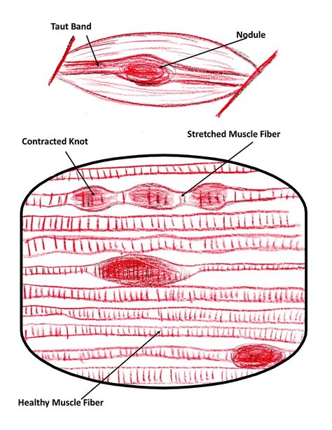 Massage & Facts on Muscle Knots ⋆ Santa Barbara Deep Tissue - Riktr PRO ...