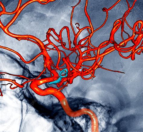 Cerebral Aneurysm Angiogram