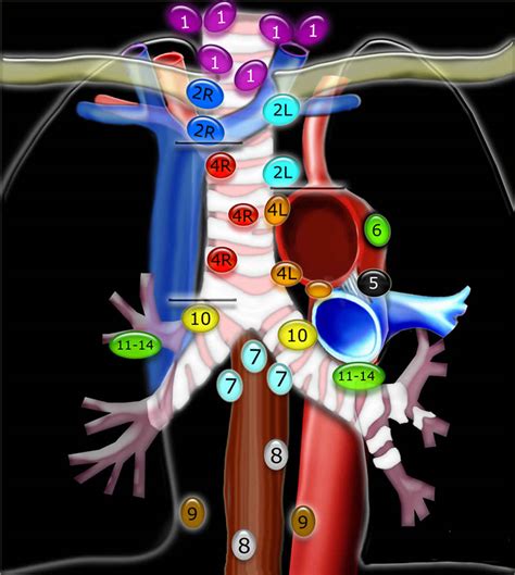 Mediastinal lymph nodes, mediastinal lymphadenopathy causes