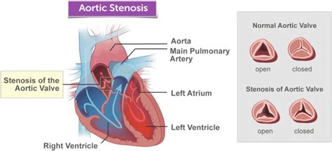 Anatomy of the aortic valve... | Download Scientific Diagram