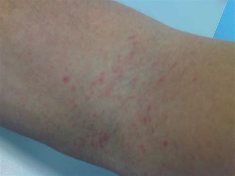 Skin Rash On Arms