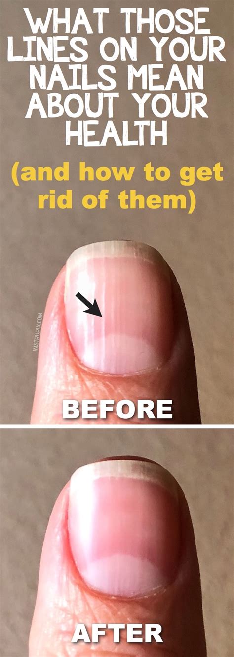 What Those Vertical Lines On Your Nails Mean About Your Health