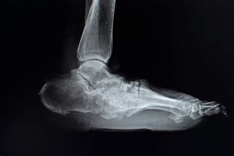 Charcot Arthropathy - Custom Orthotic