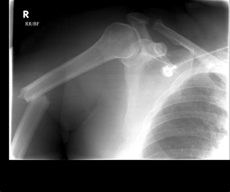 Proximal, Mid-Shaft, and Distal Humerus Fractures