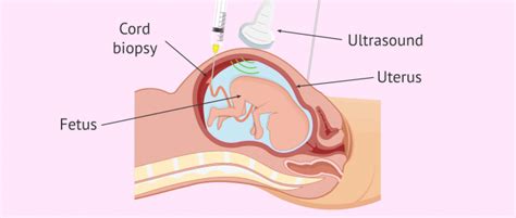 What is a Cordocentesis?