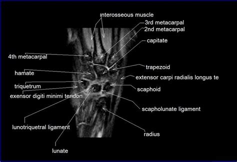 Wrist Ligaments Mri