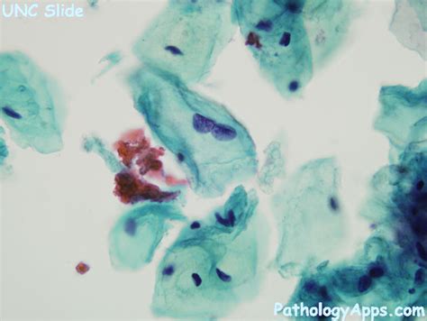 ascus cytology