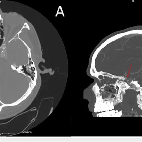 CT angiogram of the head, axial cut (A) and sagittal cut (B ...