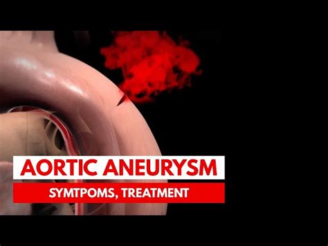 Aortic Aneurysm: Symptoms, Treatment, and Life Expectancy | SchoolTube