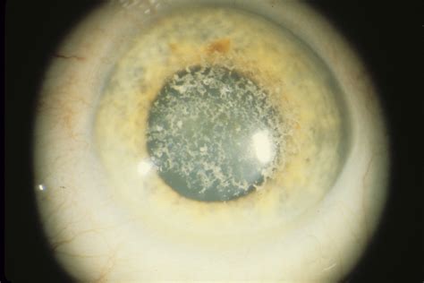 Corneal Dystrophy, Granular | Hereditary Ocular Diseases