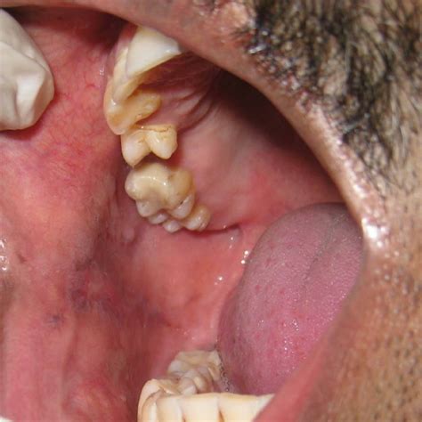 Post treatment clinical picture of right buccal mucosa | Download ...