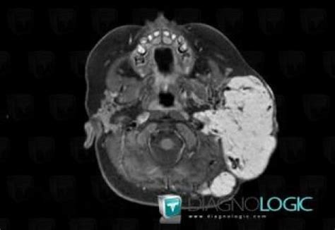 Radiology case : Hemangioma (MRI) - Diagnologic