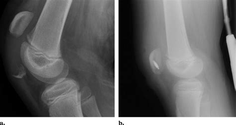 Patellar sleeve fracture in an 11-year-old boy who was injured when he ...