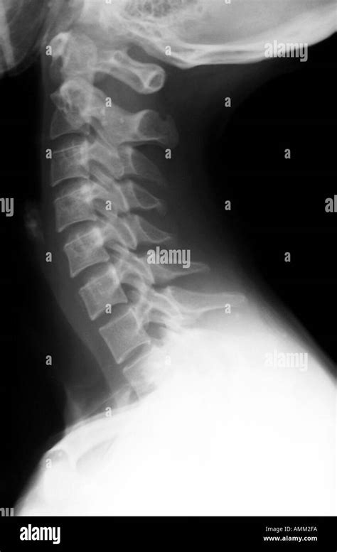 X ray normal cervical spine Stock Photo: 2835193 - Alamy