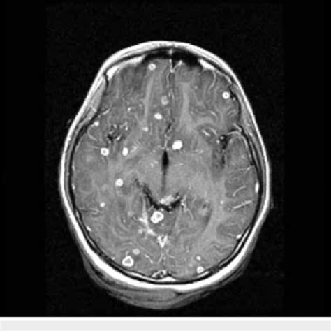 Magnetic resonance imaging (MRI) of the brain with gadolinium contrast ...