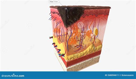 The in Stage II ALM Acral Lentiginous Melanoma Stock Illustration ...