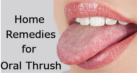 Home Remedies For Oral Thrush - Remedies Lore