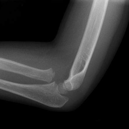 Dislocated radial head | Radiology Case | Radiopaedia.org