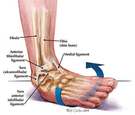 Ankle Sprains - The Institute for Athletic Medicine