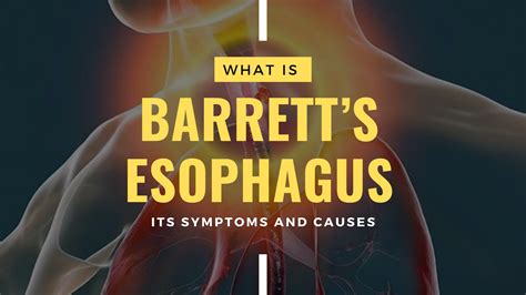 What is Barrett’s Esophagus? Symptoms and Causes