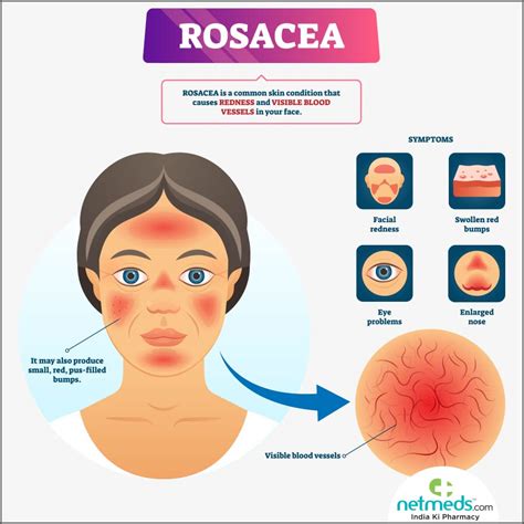 Rosacea Treatment Types Causes And Symptoms | SexiezPicz Web Porn