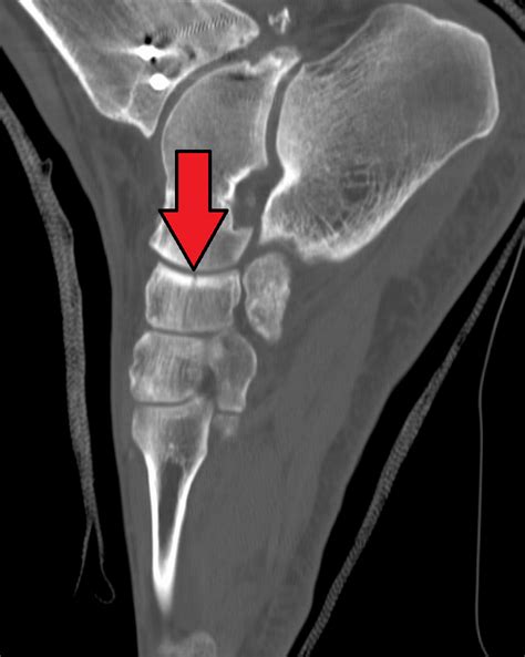 Navicular Fracture Treatment | Navicular Bone Fracture Surgery