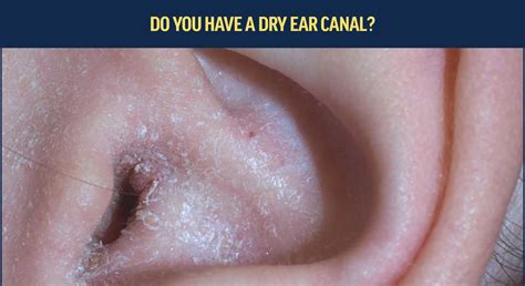 Do you have a dry ear canal? – Axel Glade