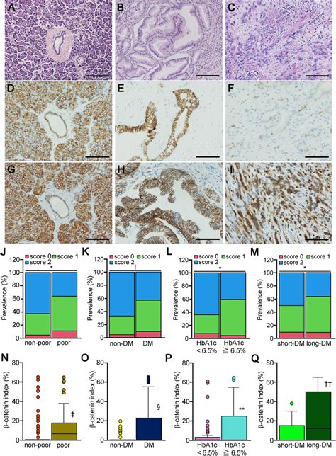 Histology of pancreatic ductal adenocarcinoma and E‐cadherin ...