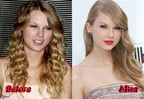 Taylor Swift Plastic Surgery Before and After