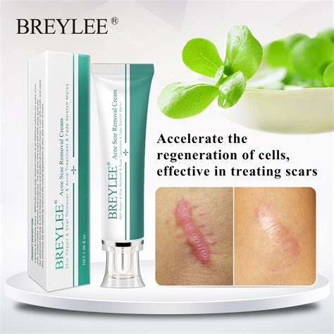 BREYLEE Acne Scar Removal Cream 30g Face Cream Skin Repair Skin Care ...