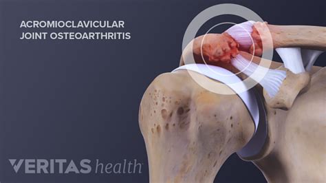 Acromioclavicular Joint Anatomy and Osteoarthritis