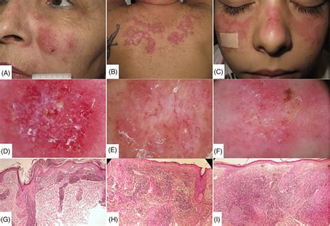 Clinical aspect of chronic cutaneous lupus erythematosus (CCLE) (A ...