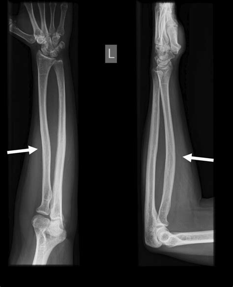 Subtle angular malunion (13°) at the proximal radial shaft can cause a ...