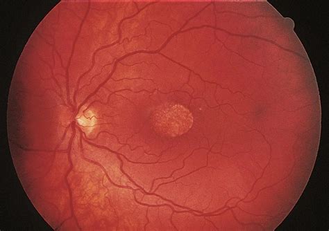 North Carolina macular dystrophy - American Academy of Ophthalmology