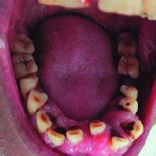 (PDF) Amlodipine Induced Gingival Hyperplasia – a Case Report and Review