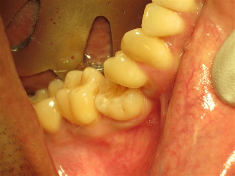 Management of ankylosed primary molars with premolar successors, aka ...