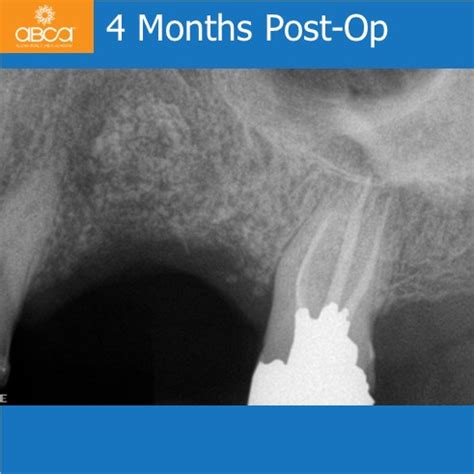 Rehabilitation after Large Cyst Removal