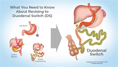 Duodenal Switch Recipes | Dandk Organizer