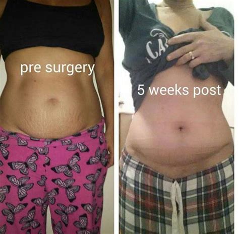 Photo tummy tuck and lipo before and after » Tummy tuck information ...