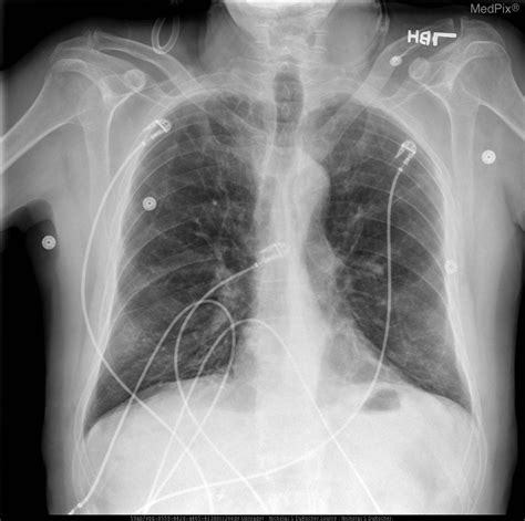 Chest X Ray Emphysema Findings