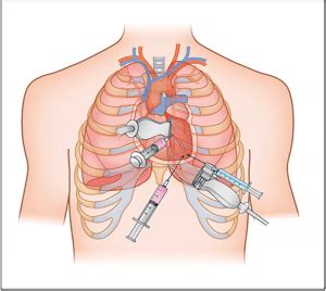 Pericardiocentesis | Emergency Medicine Education | Resus