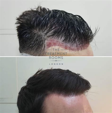 An In-Depth Guide To Receding Hairline Treatment