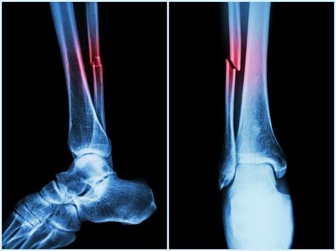 Tibia and Fibula Fractures - JOI Jacksonville Orthopaedic Institute