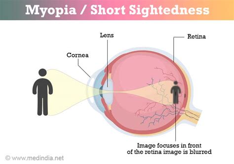 Myopia - Symptoms and Diagnosis - Treatment - FAQs