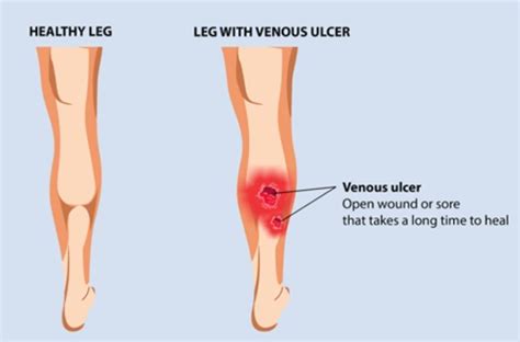 Leg ulcer | Surekha Varicose Veins Clinic | Laser Treatment fo Varicose ...