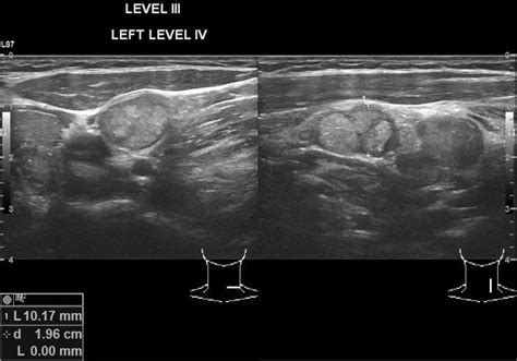 Thyroid Cancer Ultrasound