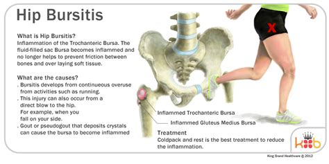 Hip Joint Bursitis Tendinitis Causes Signs Symptoms Diagnosis | Sexiz Pix