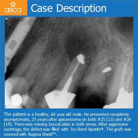 Rehabilitation after Large Cyst Removal